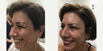 Dysport before and after photo