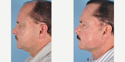 Hair Transplant before and after photo