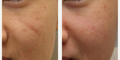 Laser Scar Removal before and after photo