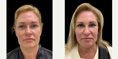 Facelift before and after photo