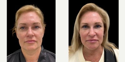 Facelift before and after photo