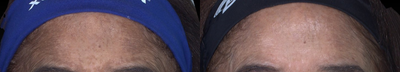 Laser Resurfacing before and after photo