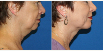 Nonsurgical Neck Lift before and after photo