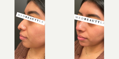 Nonsurgical Nose Job before and after photo