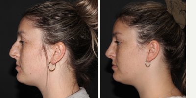 Rhinoplasty before and after photo