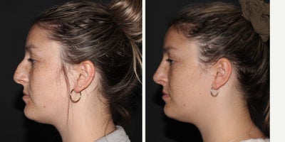 Rhinoplasty before and after photo