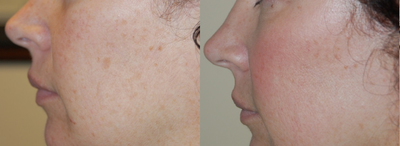 Chemical Peel before and after photo