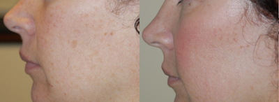 Chemical Peel before and after photo