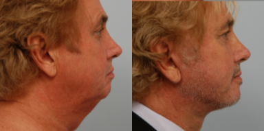 Facelift before and after photo