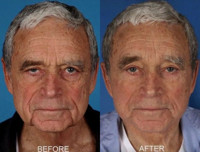 Facelift before and after photo