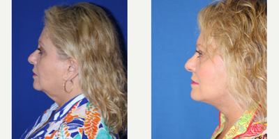Facelift before and after photo
