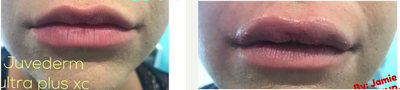 Juvederm before and after photo