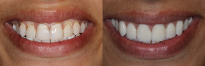 Lumineers before and after photo