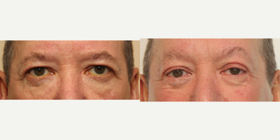 Brow Lift before and after photo
