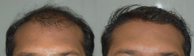 FUE Hair Transplant before and after photo