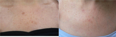 IPL before and after photo