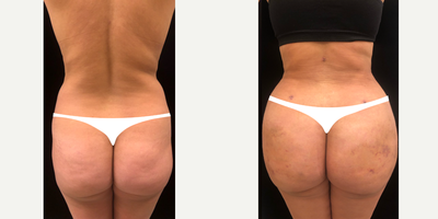 Brazilian Butt Lift before and after photo