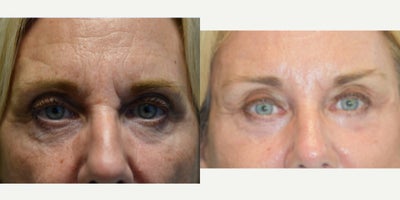 Chin Implant before and after photo