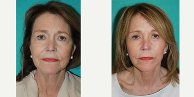 Facelift before and after photo