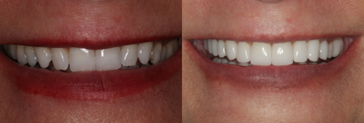 Full Mouth Reconstruction before and after photo