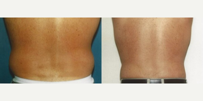 Liposuction before and after photo