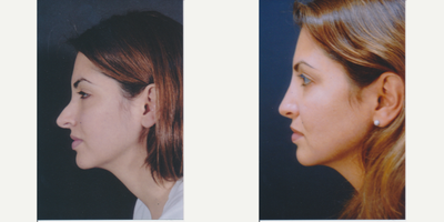 Revision Rhinoplasty before and after photo