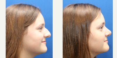 Rhinoplasty before and after photo