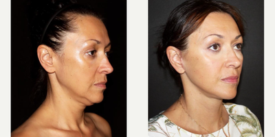 Facelift before and after photo