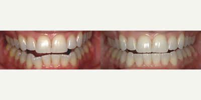 Invisalign before and after photo