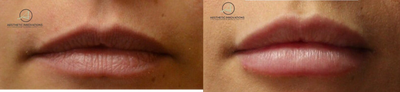 Juvederm before and after photo