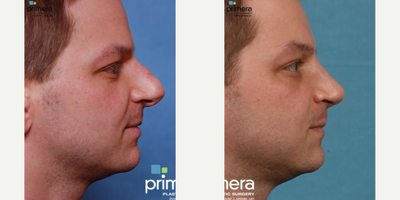 Revision Rhinoplasty before and after photo