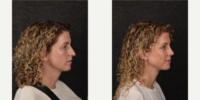 Rhinoplasty before and after photo