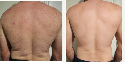 AviClear before and after photo