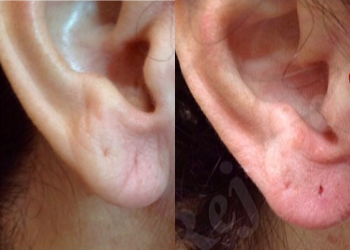 Dermal Fillers before and after photo