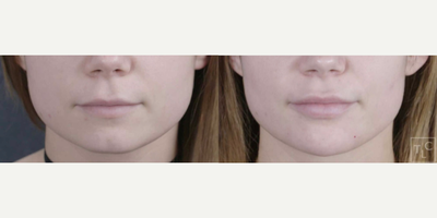 Dermal Fillers before and after photo