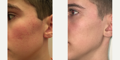 Microneedling before and after photo