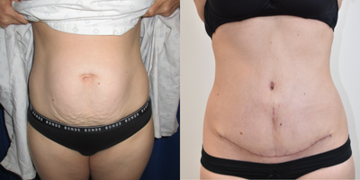 Tummy Tuck before and after photo