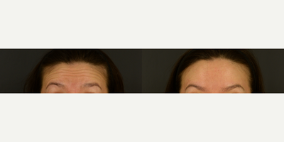 Botox before and after photo