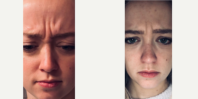 Botox before and after photo