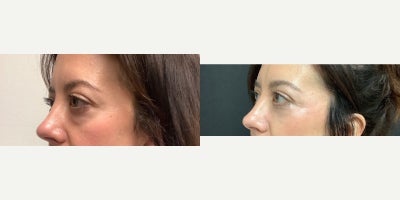 Eyelid Surgery before and after photo