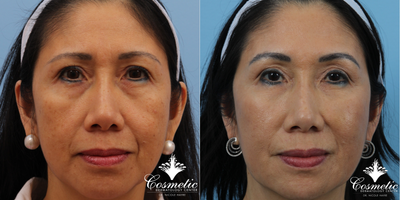 Liquid Facelift before and after photo