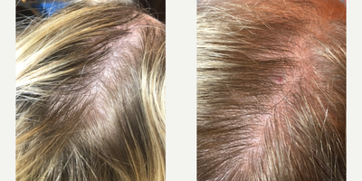 PRP for Hair Loss before and after photo