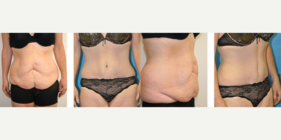 Tummy Tuck before and after photo