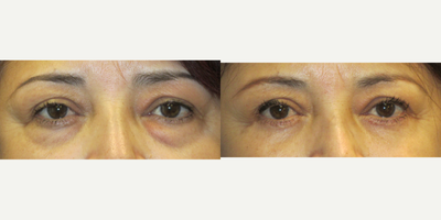Eyelid Surgery before and after photo