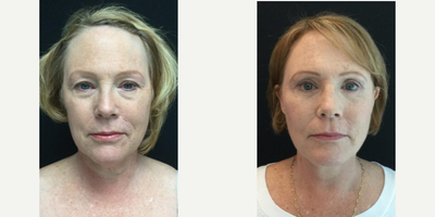 Facelift before and after photo