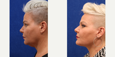 Neck Lift before and after photo