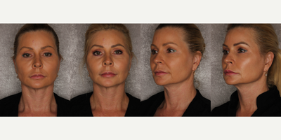 Nonsurgical Facelift before and after photo