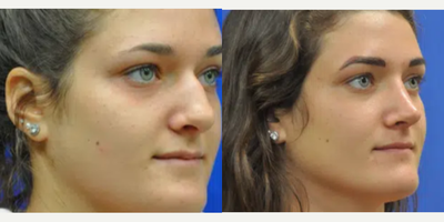 Rhinoplasty before and after photo