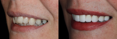 Smile Makeover before and after photo
