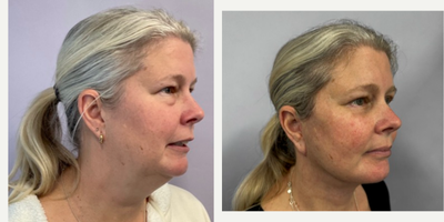 Eyelid Surgery before and after photo